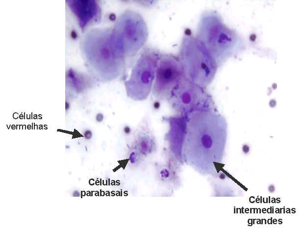 Células vermelhas, células Parabasais e Células Intermediárias Grandes