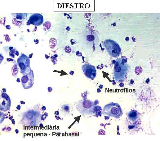 Diestro - Neutrófilos e Intermediária pequena Parabasal