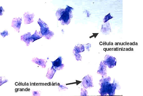Estro - Célula anucleada queratinizada e Célula Intermediaria Grande
