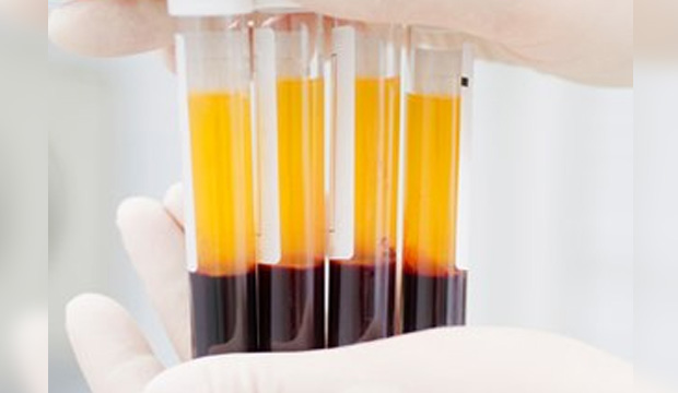 O plasma, depois de separado pelo PRP, será injetado no local atingido com o objetivo de regenerar de forma mais rápida lesões